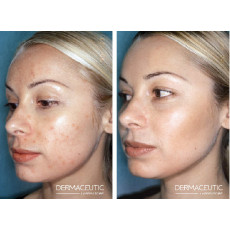 Dermaceutic Milk Peel  box kit 奶滑果酸換膚