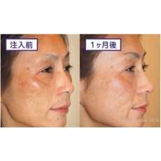 Melsmon Placenta美思滿胎盤素